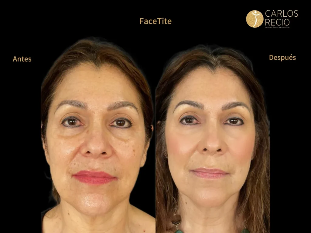 Recuperación después de un facelift: día a día, cuidados y cuándo puede volver a su rutina Recuperación después de un facelift: día a día, cuidados y cuándo puede volver a su rutina
